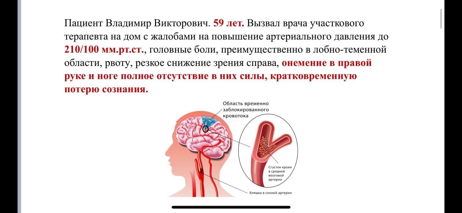 Венозный инсульт головного мозга. Профилактика острых нарушений мозгового кровообращения. Венозный инсульт. ОНМК В задней мозговой артерии. Острое нарушение мезентериального кровообращения профилактика.