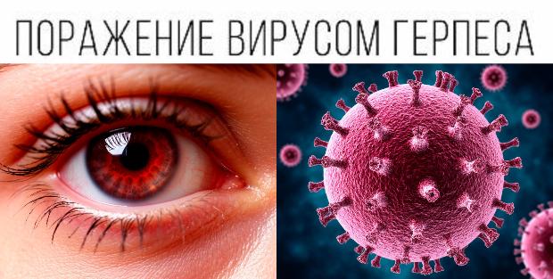 Интернет-проект «Офтальмолог рядом». Лечение герпетической болезни глаза Интернет-проект «Офтальмолог рядом». Лечение герпетической болезни глаза