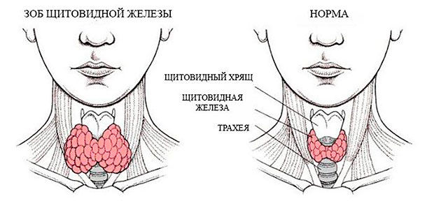 Заболевания щитовидной железы: симптомы, признаки, лечение - МедКом